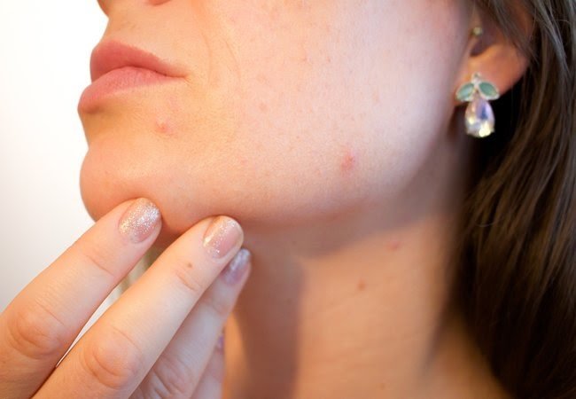 9 possible causes of blackheads on the face