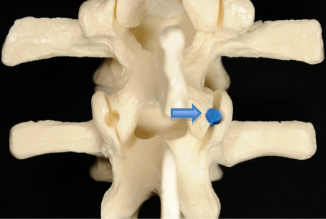 Methodologies to Facet Fusion for Endoscopic Component