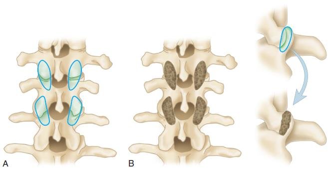 Important Things To Consider When You Go For Facet Fusion